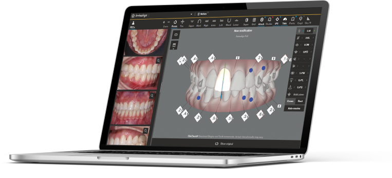 Align Technology Announces Next Series of Innovation With Invisalign(R) G7  and ClinCheck Pro 5.0 Software